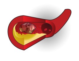 възстановяване на говора след инсулт в Русе 