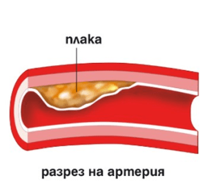 терапия на говора след инсулт Русе 