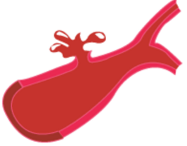 поражения след инсулт и възстановяване Русе 